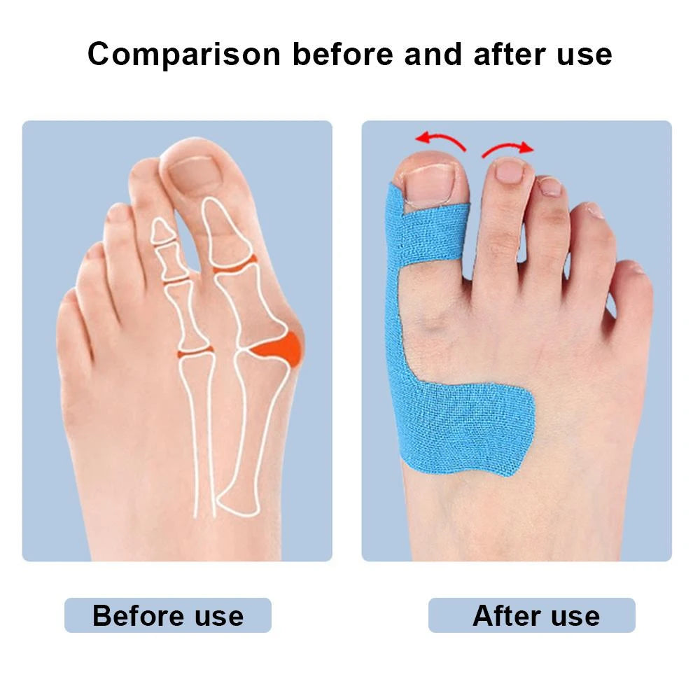 Comparison of foot structure before and after using kinesiology tape for bunions and toe support