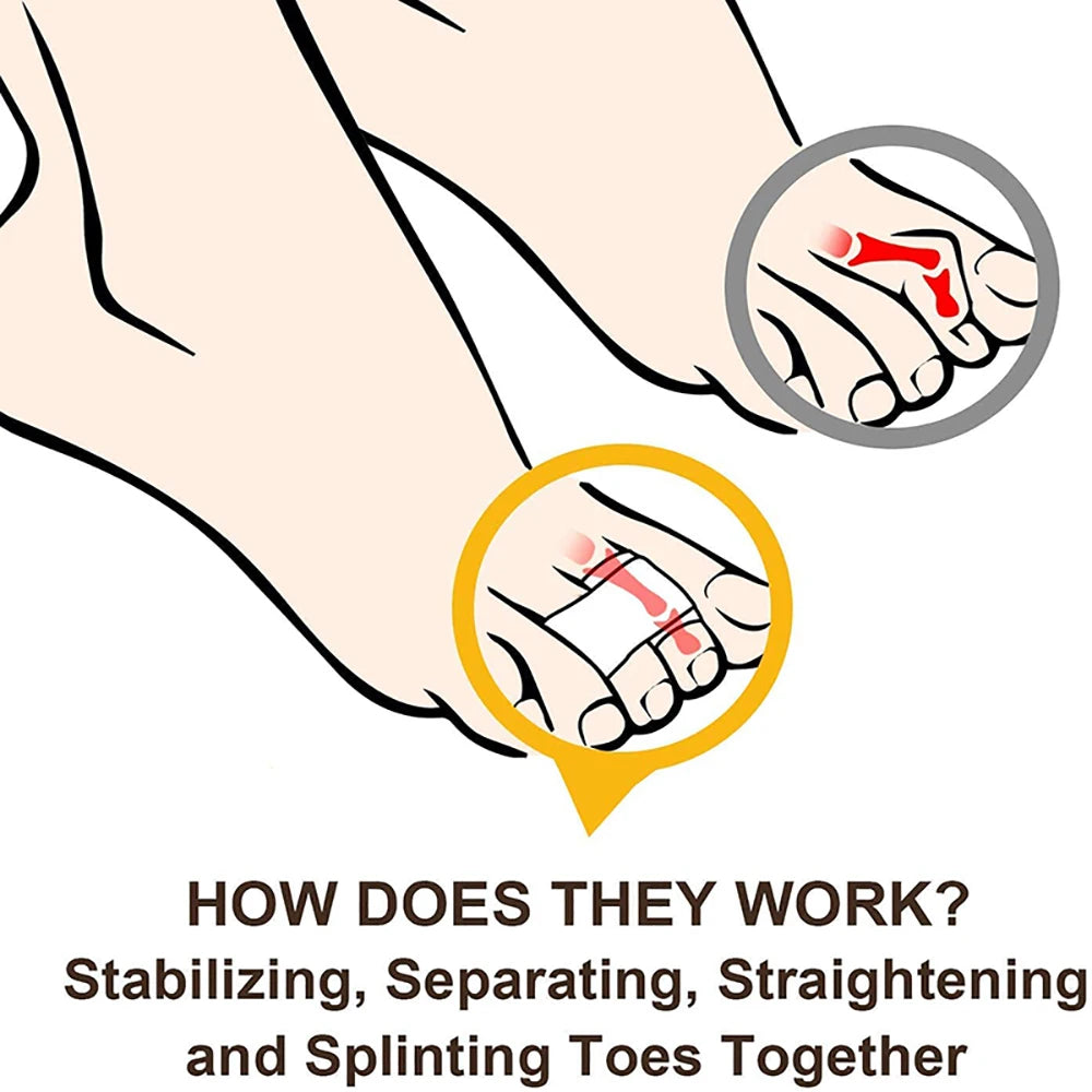 Diagram showing how orthopedic toe wraps stabilize, separate, straighten, and splint toes together.
