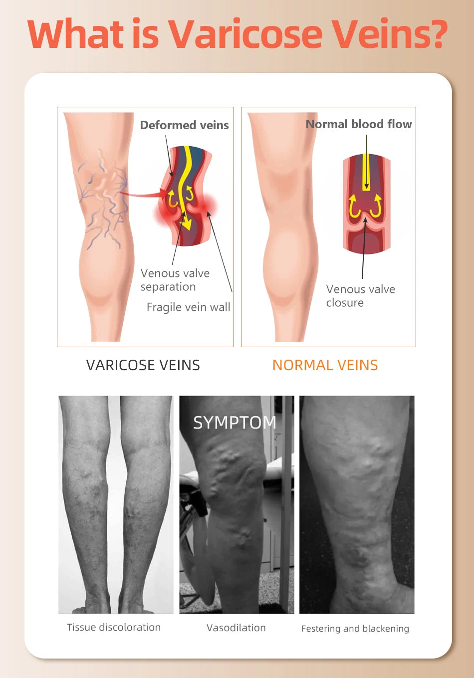 Infographic explaining varicose veins and normal veins, showing symptoms like tissue discoloration and fever.