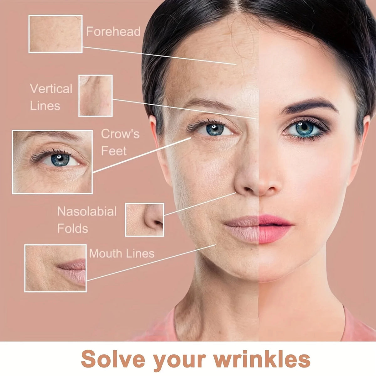 Diagram showing various facial lines like forehead, crow's feet, nasolabial folds, and mouth lines to illustrate wrinkle smoo
